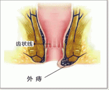 图说疾病 外痔百科 外痔发生于肛管齿线以下,是痔外静脉丛扩大曲张或