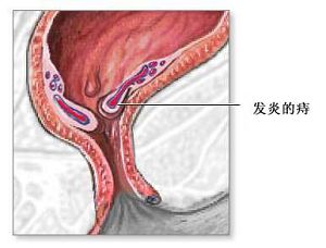 痔疮具体的症状有哪些